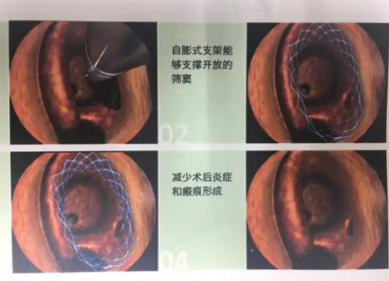 全降解鼻竇藥物支架系統(tǒng)bms014217ds01